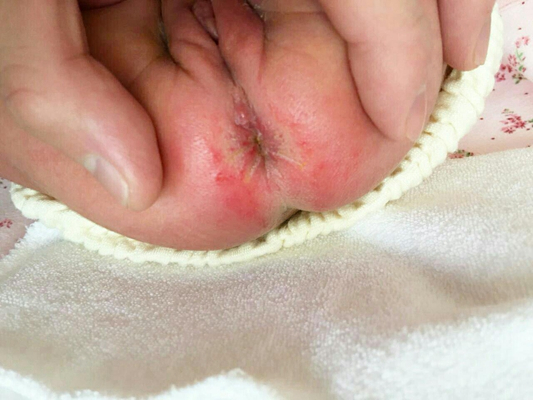 嬰兒肛周膿腫 (46) 