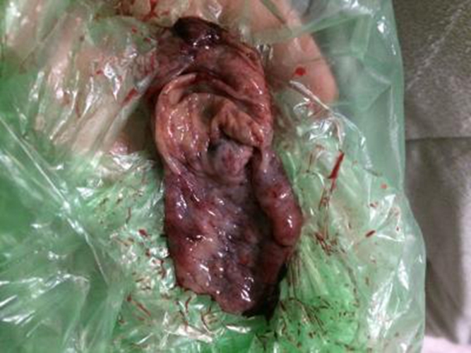 早孕藥流排出的孕囊實體