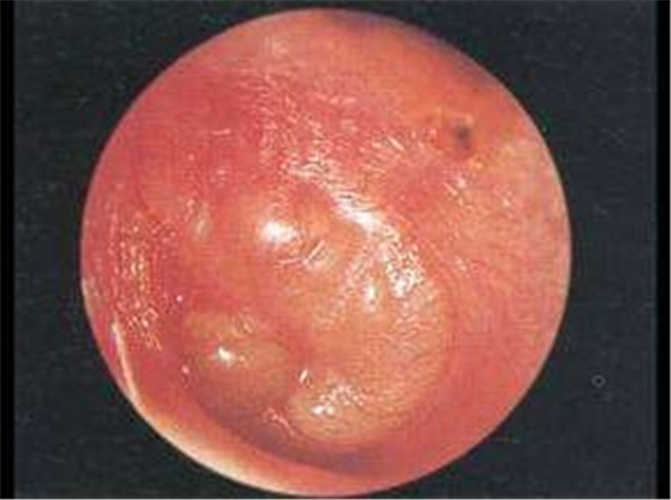 嚴重急性中耳炎