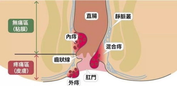 內痔瘡 (45) 