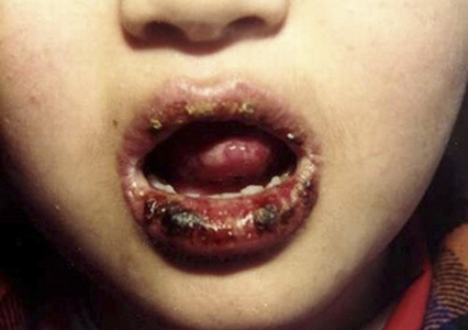 系統性紅斑狼瘡診斷標準 (47) 