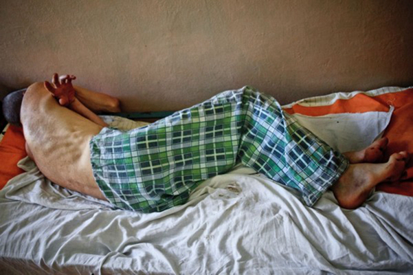 空洞型肺結核能活多久 (42) 