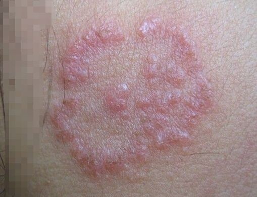 體股癬初期現象