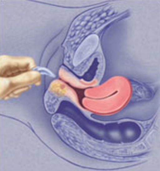 人工陰道治療中的
