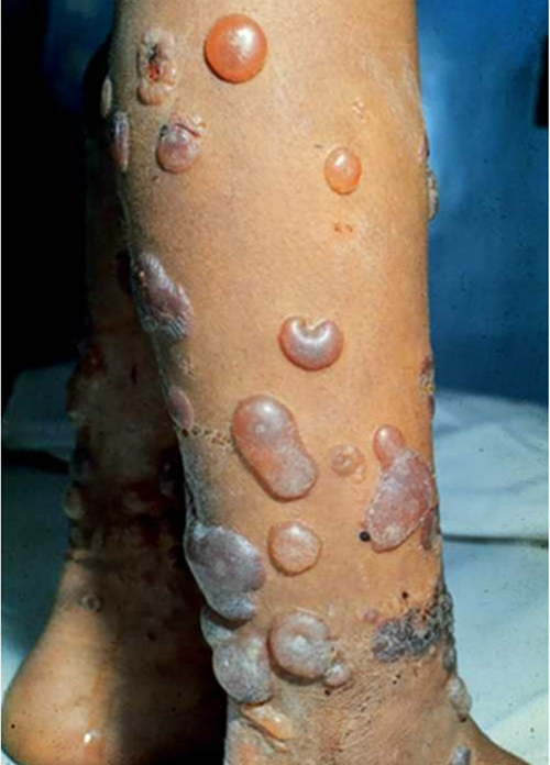 大皰性皮膚病腿部