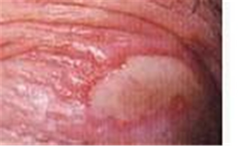 白塞病中期症狀