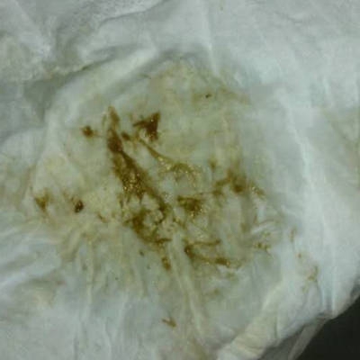 先兆流產分泌物