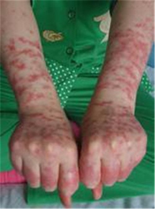 白塞病雙手