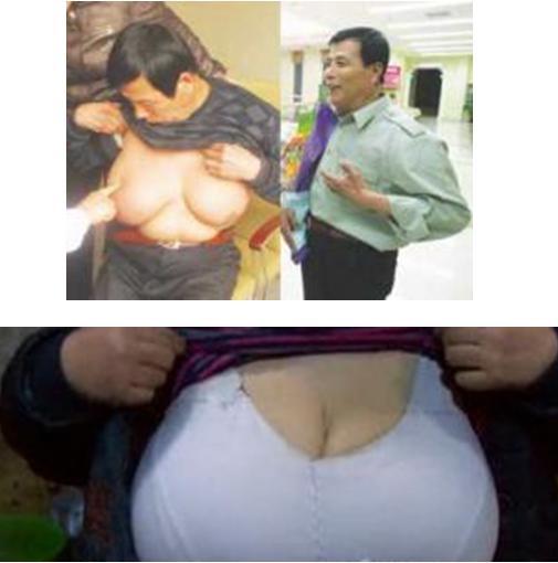 男性乳房肥大是肺癌巨乳症