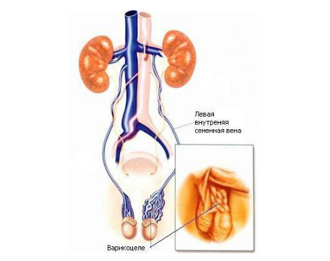 精索曲張睪丸下墜時