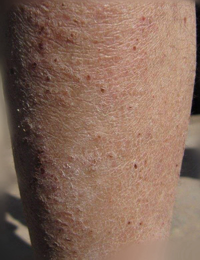 小腿皮膚像魚鱗 (58) 