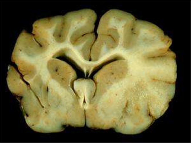 散發性腦炎伴精神障礙