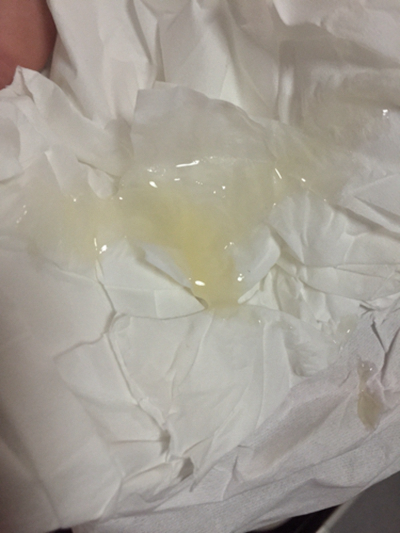 不正常精液液化