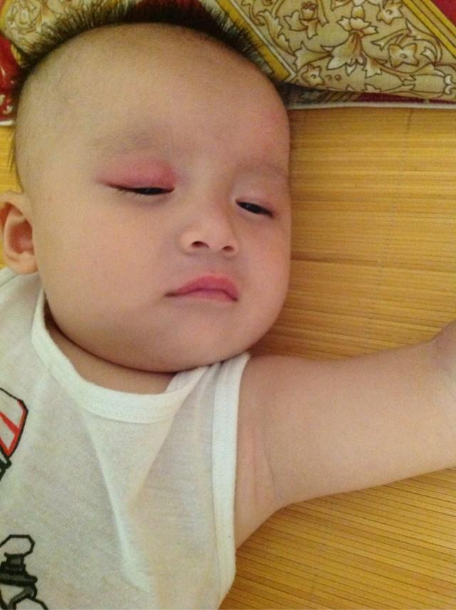 先天性青光眼 嬰兒