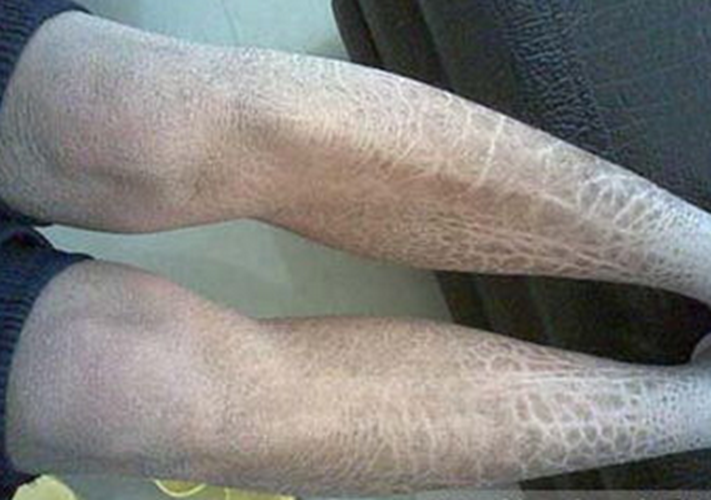 腿部的皮膚黑變病