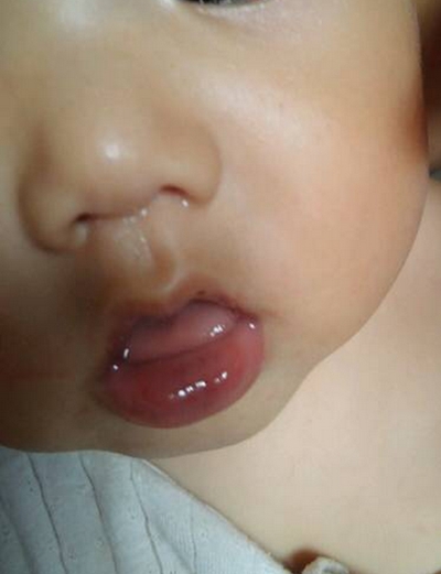 嬰兒嘴唇發紫 (48) 
