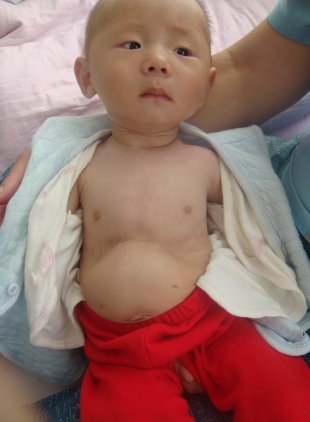 寶寶缺鈣雞胸圖 (56) 