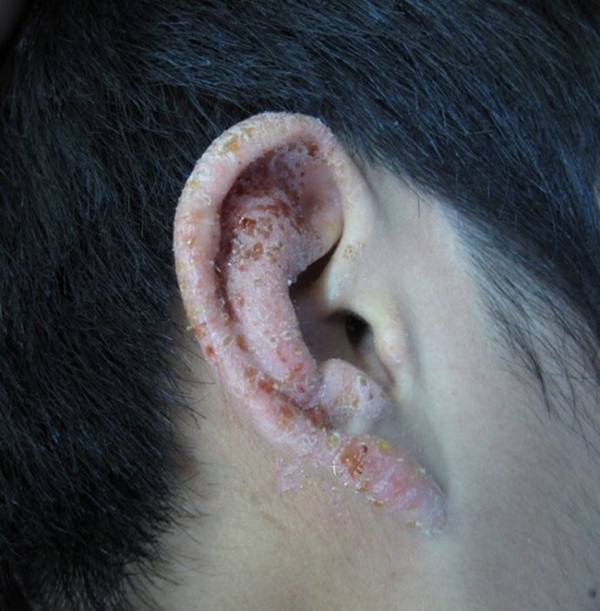 耳朵異位性皮炎