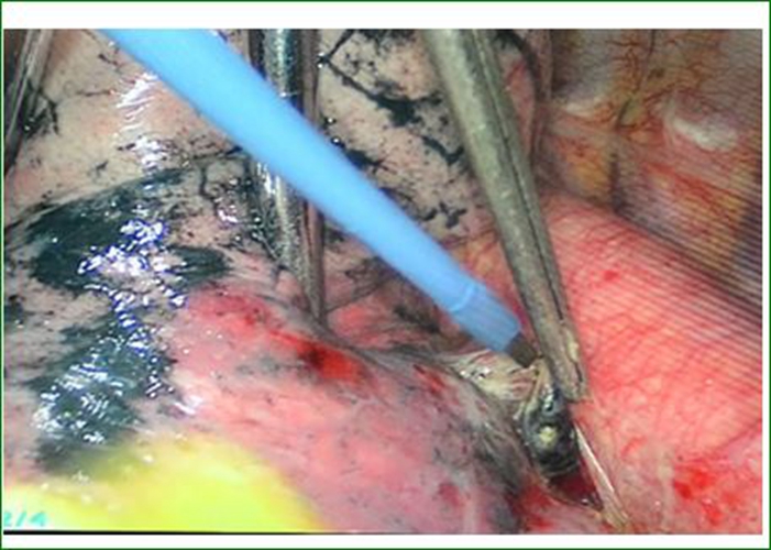 一位早期肺腺癌患者的手術