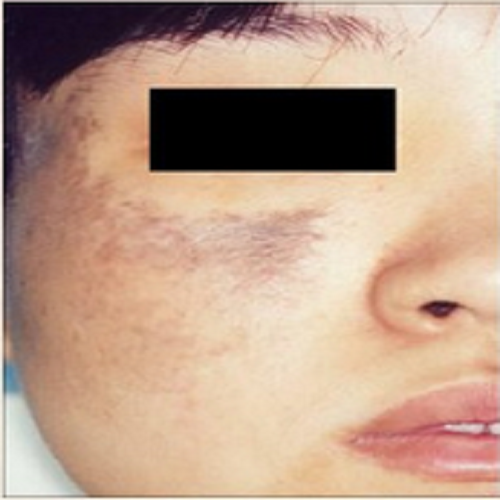 顏色淺的太田痣