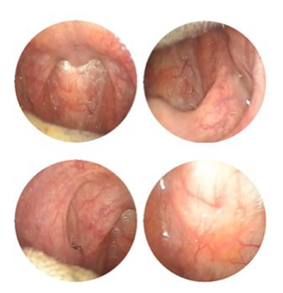 喉部淋巴濾泡增生 (39) 