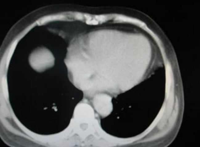 肋間神經炎疼痛部位
