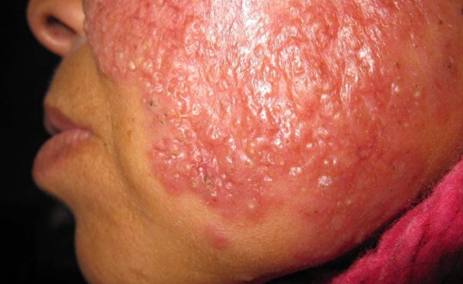 紅斑結節圖 (59) 