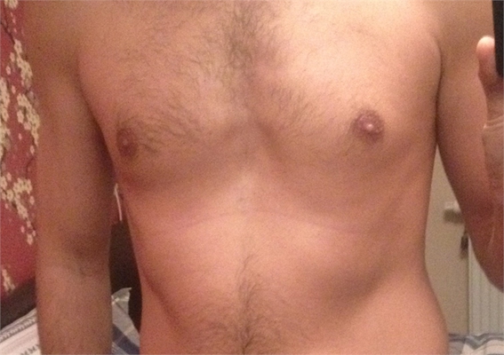 男生胸部突出 (6) 