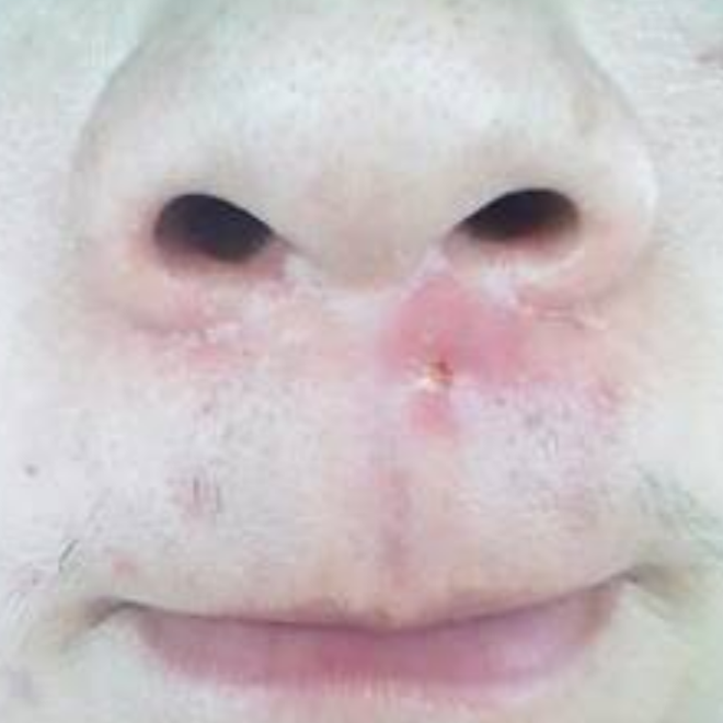 臉部皮囊炎怎麼治療 