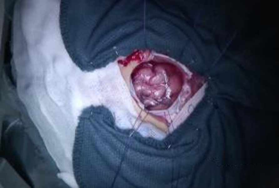 煙霧病血管縮小