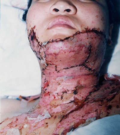 深二度燒傷 (44) 