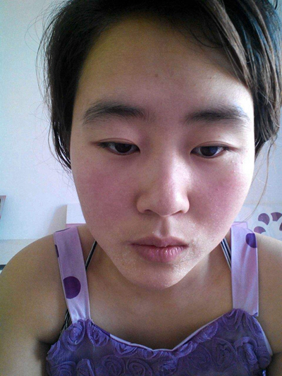 神經性皮炎的治療 (54) 