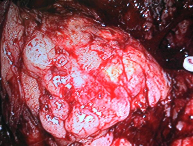 手術中看到的腎上腺腫瘤