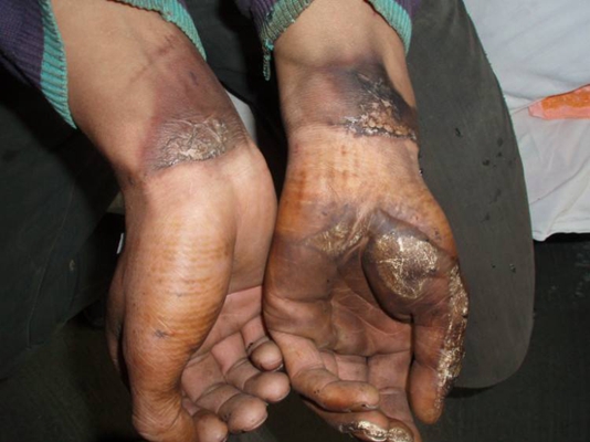 深二度燒傷 (45) 