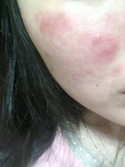 急性皮炎的症狀