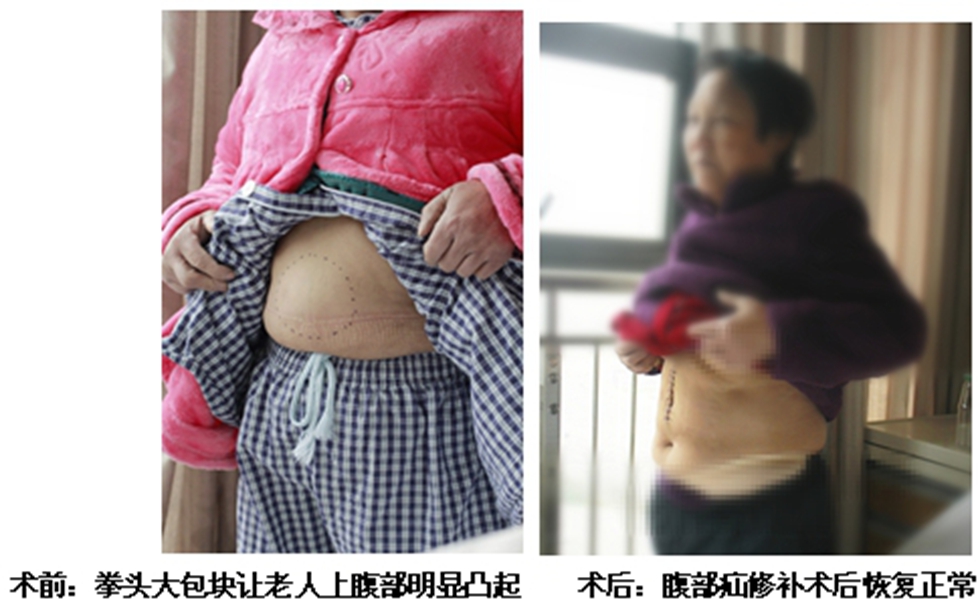 白線疝治療前後