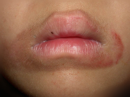 嘴上長皰疹 (9) 