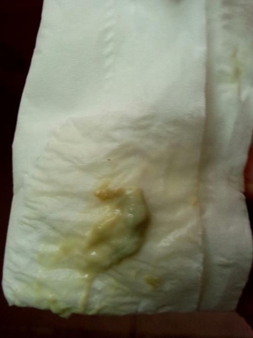 白帶發黃外陰瘙癢