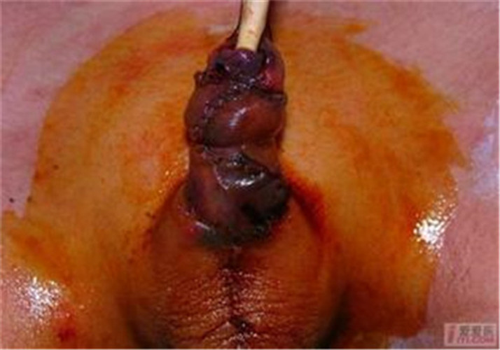 重度先天性尿道下裂