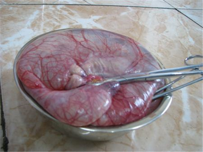 切除的巨大卵巢囊腫