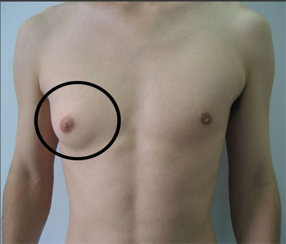 男性假兩性畸形胸部症狀