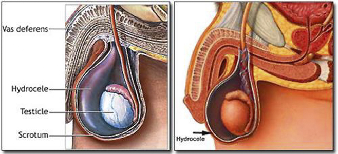 小兒鞘膜積液 (36) 