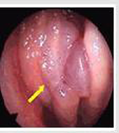 左鼻腔內的慢性鼻炎