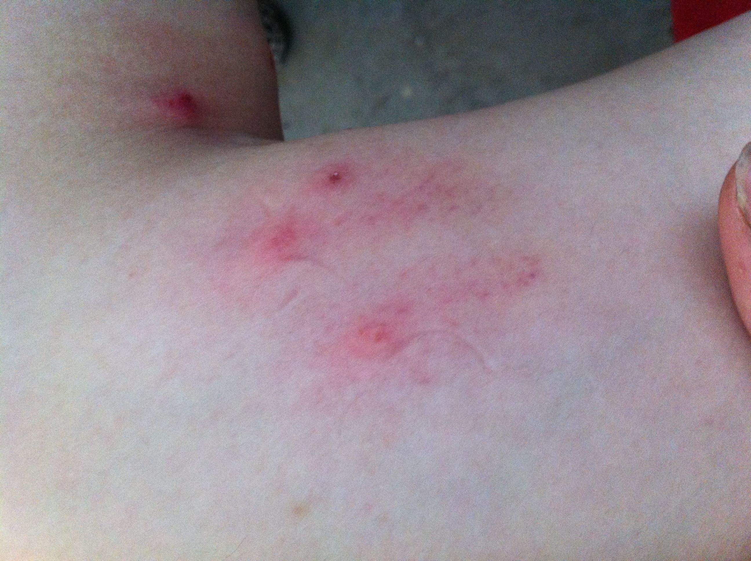 被跳蚤咬的症狀