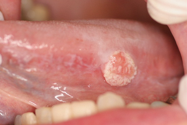 舌癌的初早期症狀