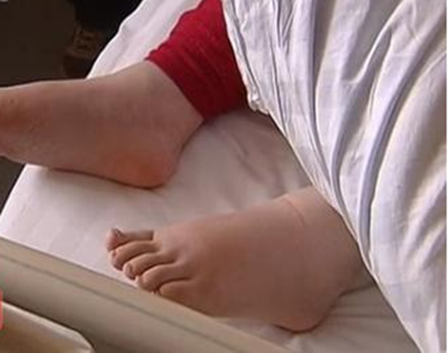 糖尿病腎病影響生活