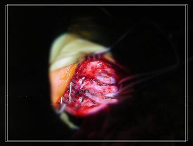 煙霧病晚期症狀