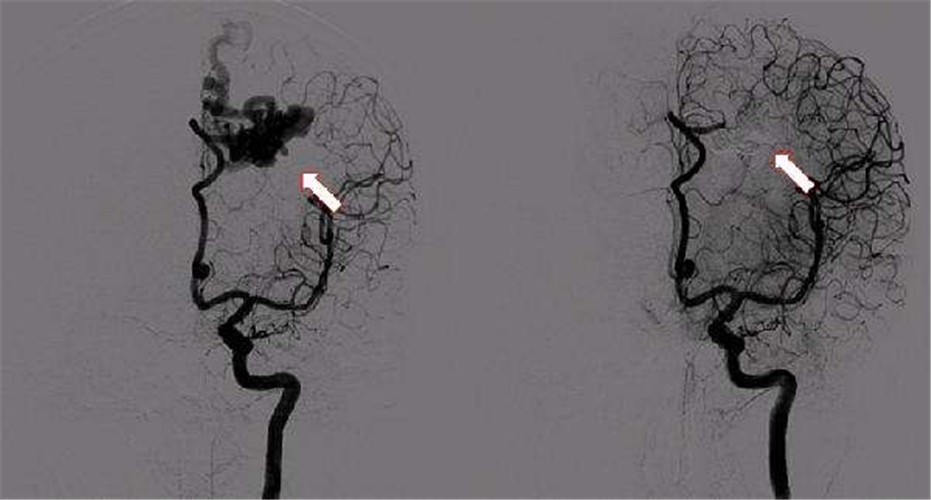左頸內動脈狹窄導致腦供血不足