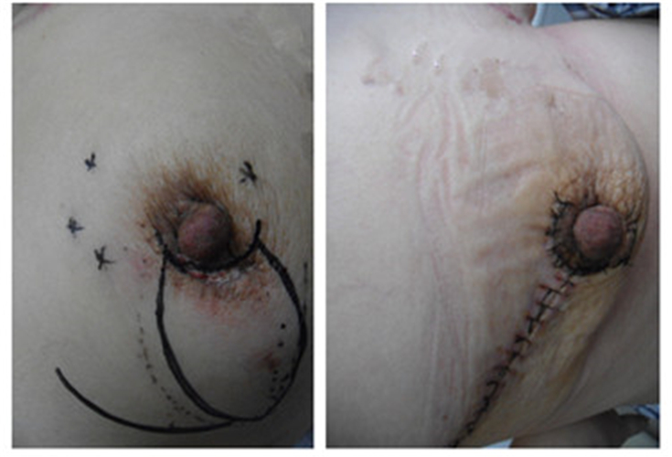 治療乳腺纖維瘤手術