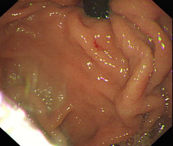 急性胃炎症狀的